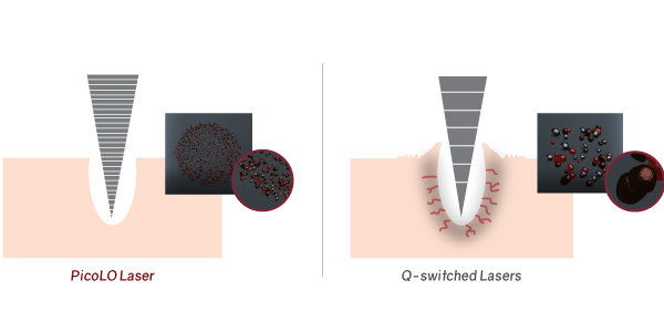 Vantagens do Picolo Laser: não agride a pele