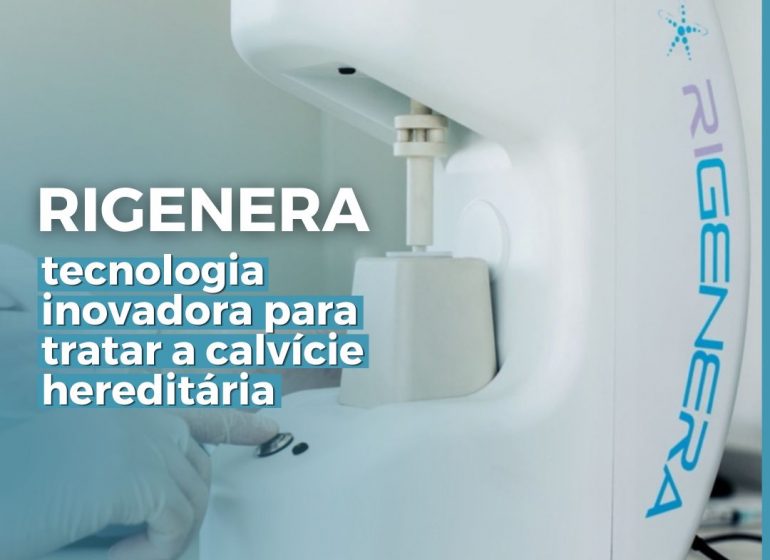Rigenera: tratamento para calvície hereditária - Ricardo Fenelon Dermatologista Brasília