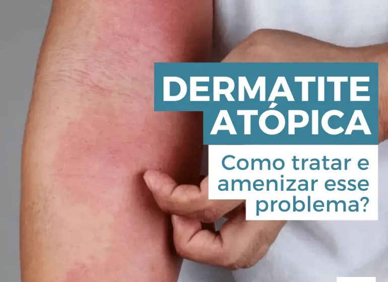 Dermatite Atópica: como tratar e aliviar esse problema? - Ricardo Fenelon Dermatologista Brasília